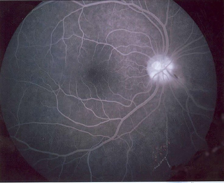 Angiographie à la fluorescéine