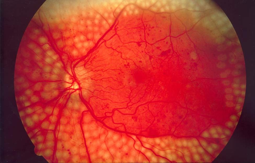Cicatrices de photocoagulation sur la rétine