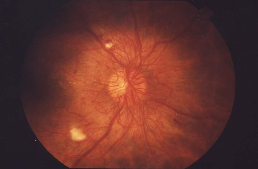 Rétinopathie diabétique proliférante